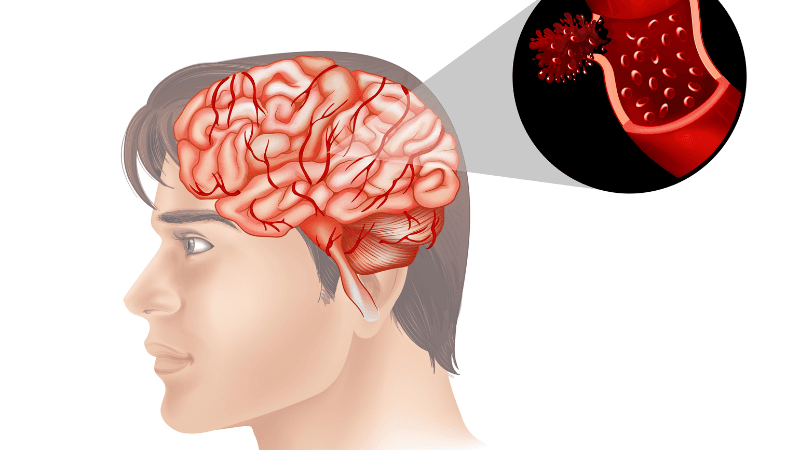 Tai biến mạch máu não bộ y tế.