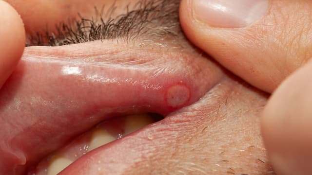 Giới thiệu 5 thuốc bôi nhiệt miệng phổ biến nhất