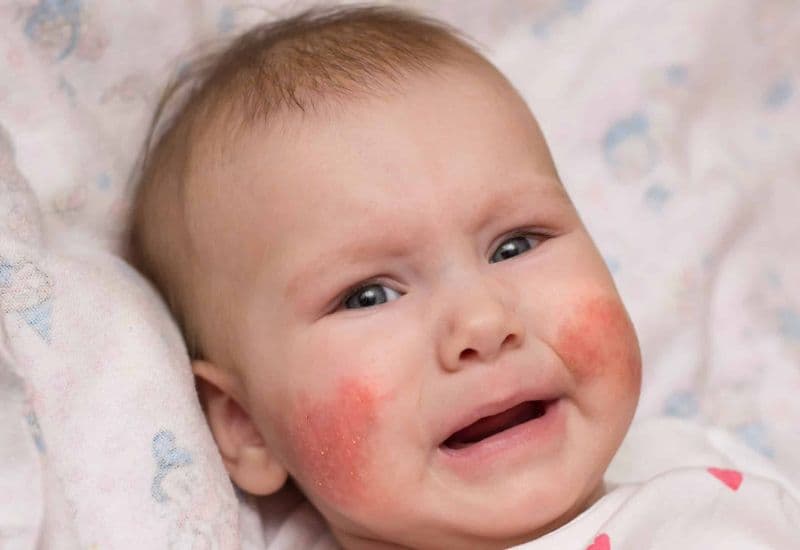 Kem dưỡng Latopic: Hỗ trợ điều trị chàm sữa