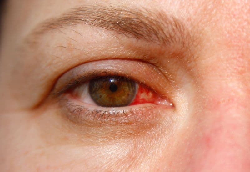 Mắt đỏ là triệu chứng phổ biến nhất của viêm kết mạc cấp tính.