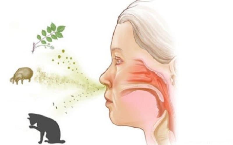 Nguyên nhân viêm xoang dị ứng