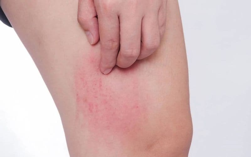 Dùng Hightamine quá liều có thể dẫn đến triệu chứng nổi mề đay