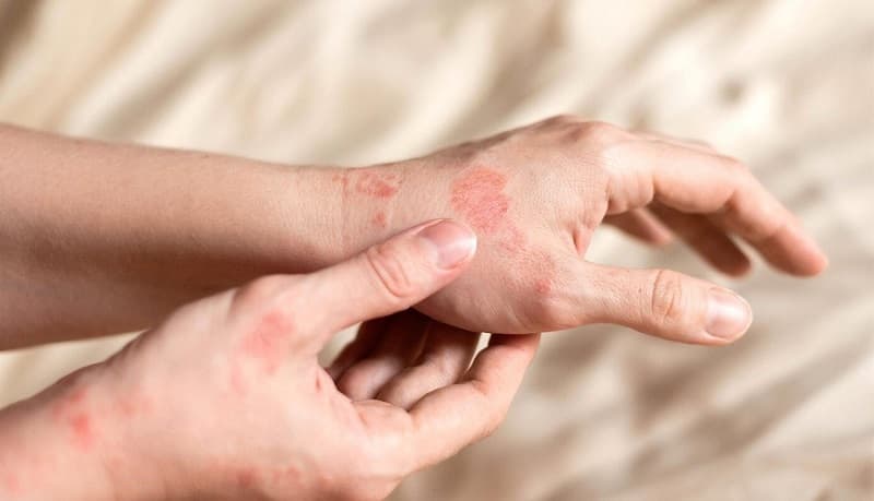 Vì sao Itraconazole có thể điều trị nấm?