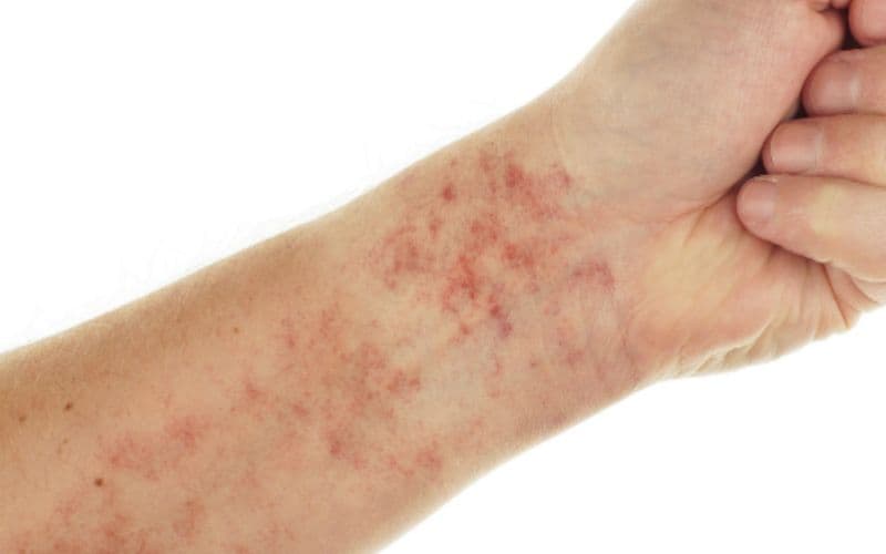 Menison 16mg được sử dụng để điều trị bệnh lupus ban đỏ