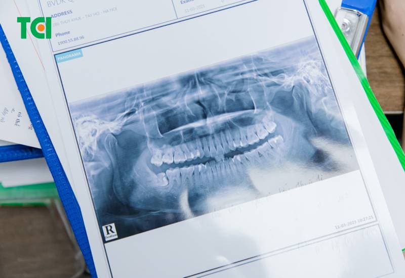 hình ảnh nhổ răng khôn