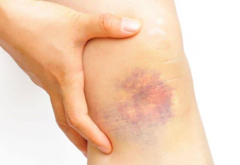 chấn thương phần mềm gây bầm tím