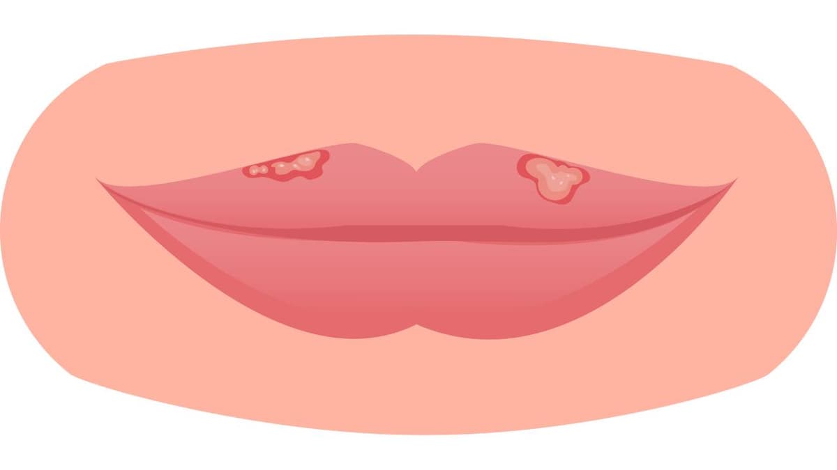 Bệnh Herpes là gì, giải đáp của chuyên gia
