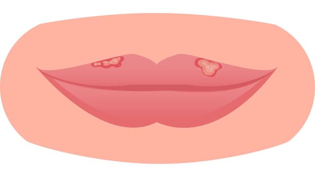 Bệnh Herpes là gì, giải đáp của chuyên gia
