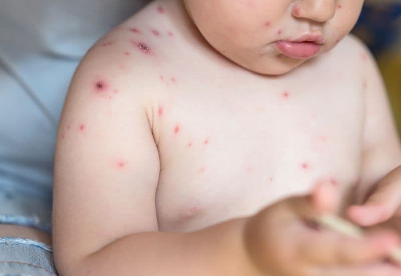 Tổn thương da do thủy đậu phát triển qua nhiều giai đoạn và có đặc điểm khá đặc trưng, giúp dễ dàng nhận biết thủy đậu.