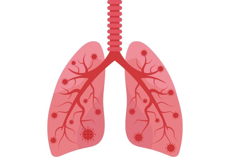 Bệnh viêm phế quản phổi là bệnh lý nhiễm trùng phế quản và phế nang phổi.