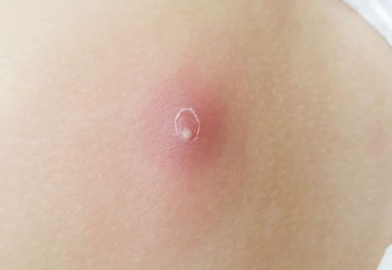 bị áp xe nông dưới da