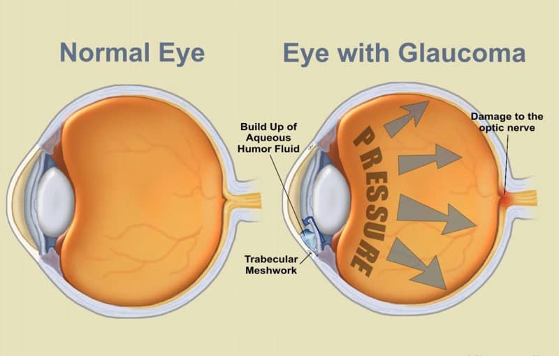 viêm nội nhãn có nguy cơ tiến triển thành Glaucoma