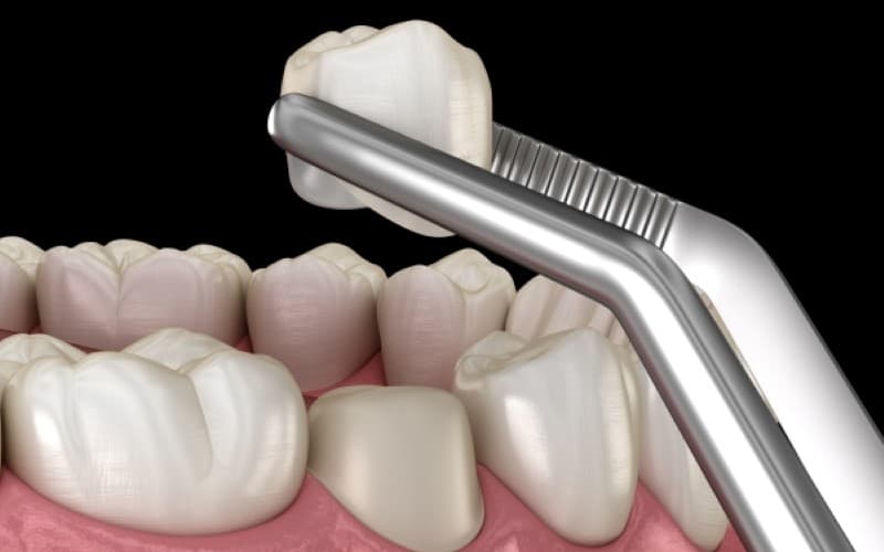 Bọc răng sứ có tốt không?