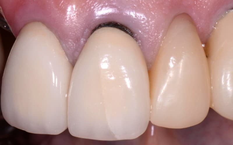 Ảnh hưởng bọc răng sứ bị đen nướu