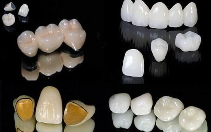 Hạn chế bọc răng sứ kim loại