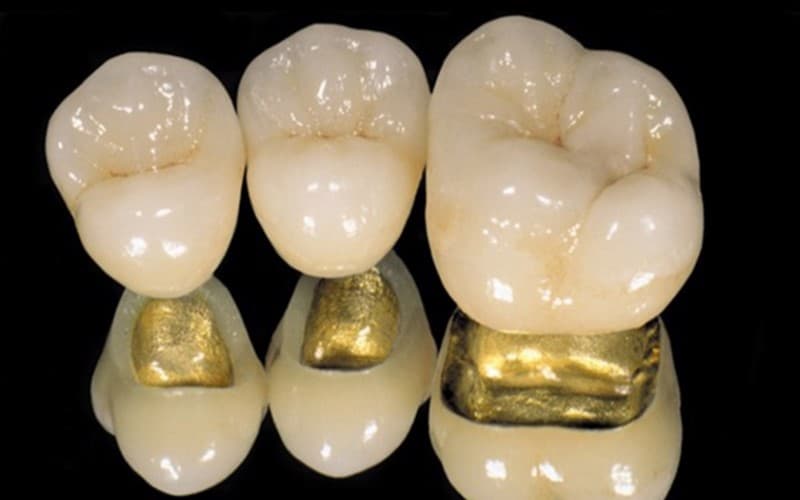 Răng sứ vàng