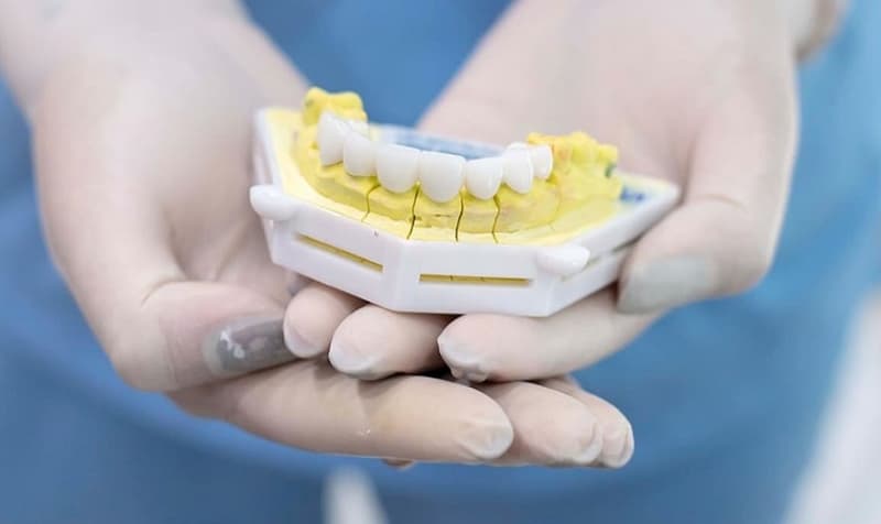 Quá trình bọc răng sứ lần 2