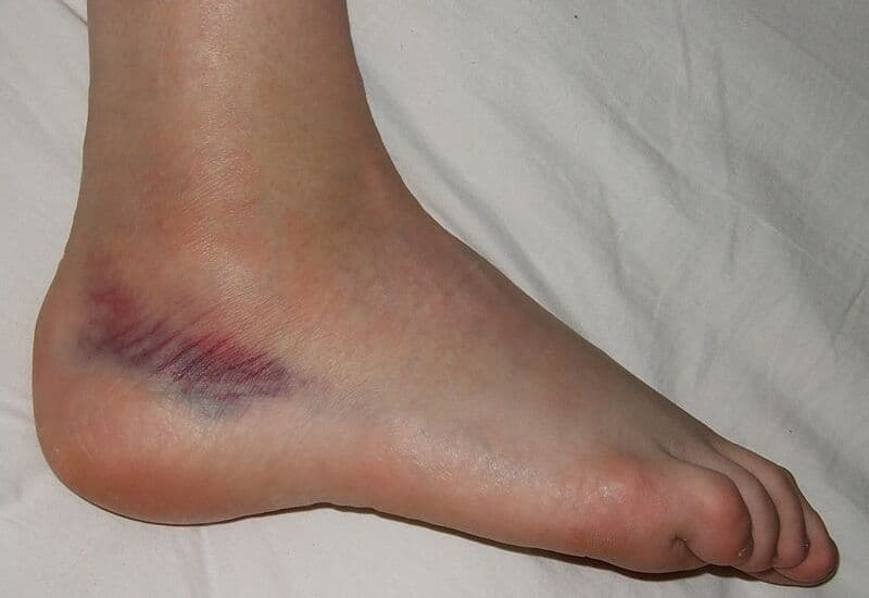 bong gân là một dạng của chấn thương phần mềm