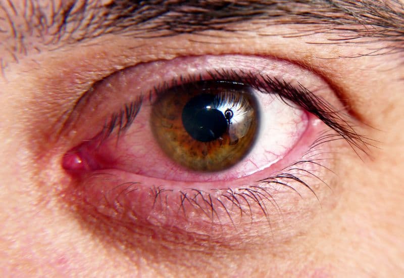 Mạch máu ở kết mạc giãn nở làm mắt trở nên đỏ hoặc hồng, tùy mức độ nghiêm trọng của bệnh.