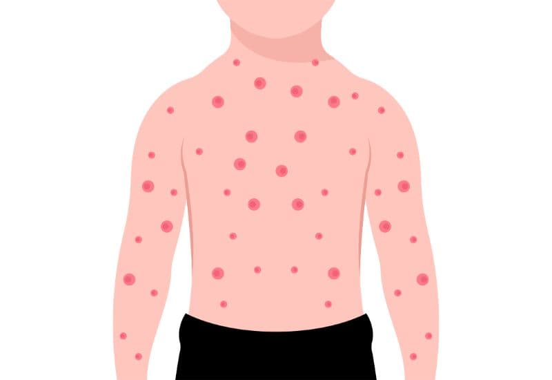 Thủy đậu thường xuất hiện như một đợt bùng phát các tổn thương da đặc trưng. 