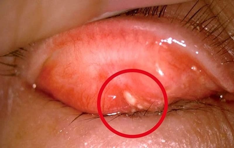 Có hạt trong mắt do nhiều nguyên nhân