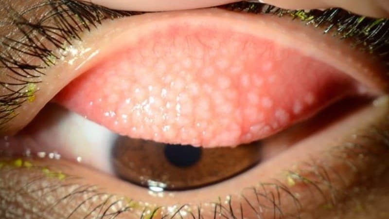 đau mắt hột có hạt trong mắt