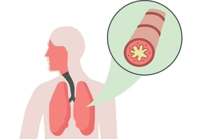 Phế quản là một phần của hệ hô hấp, chịu trách nhiệm vận chuyển không khí vào và ra khỏi phổi. Bắt đầu từ cuối thanh quản, phế quản chia thành hai nhánh chính là phế quản trái và phế quản phải, mỗi nhánh dẫn không khí vào một bên phổi tương ứng. Khi vào phổi, mỗi nhánh phế quản chính tiếp tục phân thành các phế quản nhỏ hơn, được gọi là phế quản thùy và cuối cùng là tiểu phế quản.