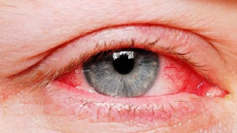 Hình ảnh mắt bị bệnh đau mắt đỏ (viêm kết mạc)