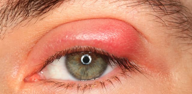 5 Bệnh lý gây đau mí mắt trên sưng tấy không nên chủ quan