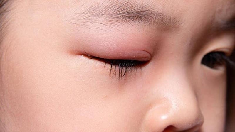 Hình ảnh mi trên bị sưng đau