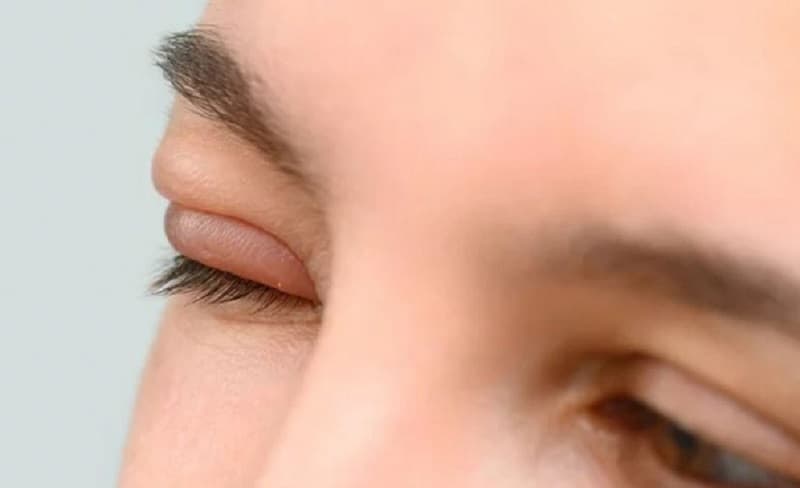 Nhiều trường hợp đau mí mắt do nhiễm virus