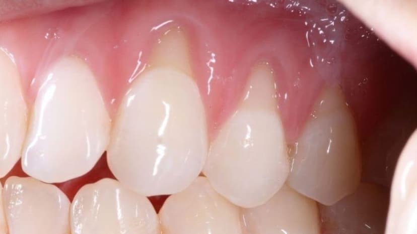 Những lưu ý sau khi thực hiện hàn cổ răng