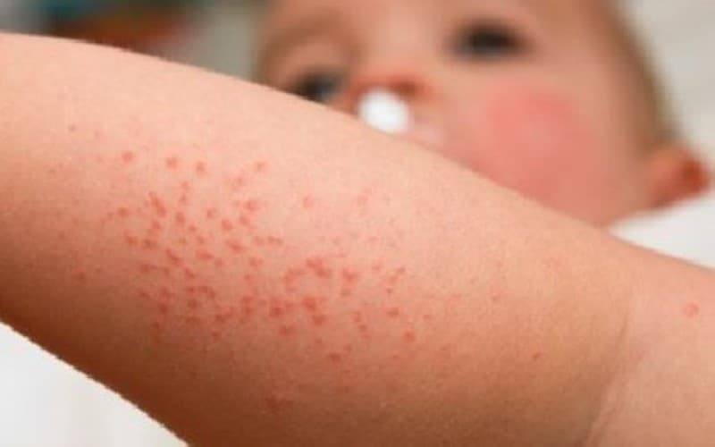 Tình trạng bệnh herpes ở trẻ em