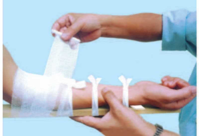 hướng dẫn nẹp khi bị gãy xương cẳng tay