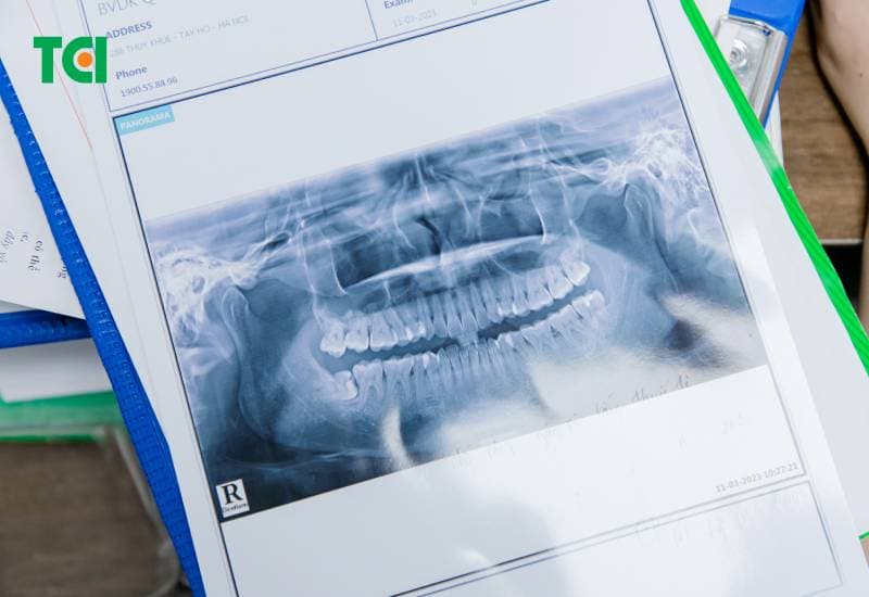 lý giải khi nào nhổ răng khôn 