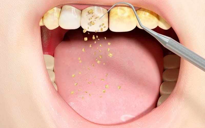 Xử lý mảng bám răng