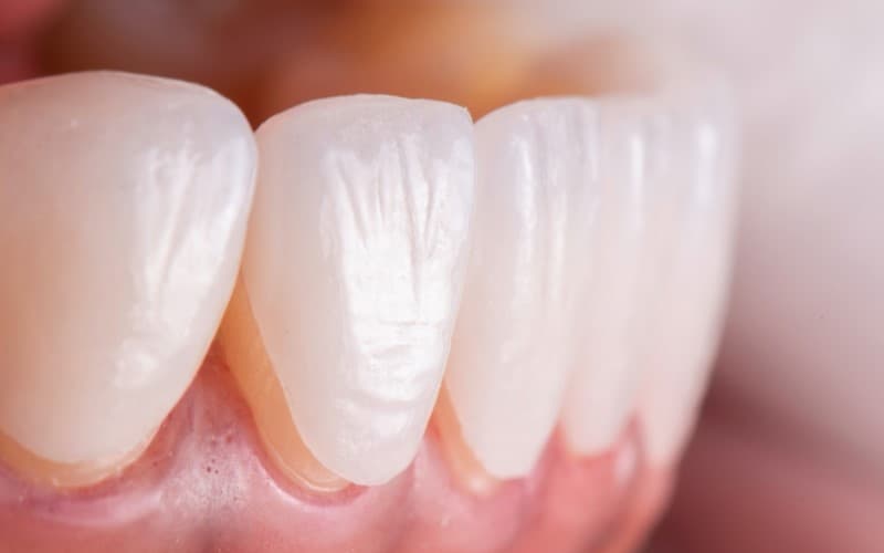 Quá trình dùng mặt dán sứ Veneer