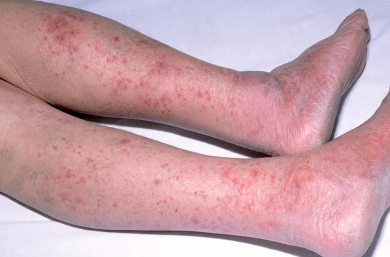 Viêm màng não do mô cầu là căn bệnh rất nguy hiểm, để lại nhiều hậu quả nặng nề.