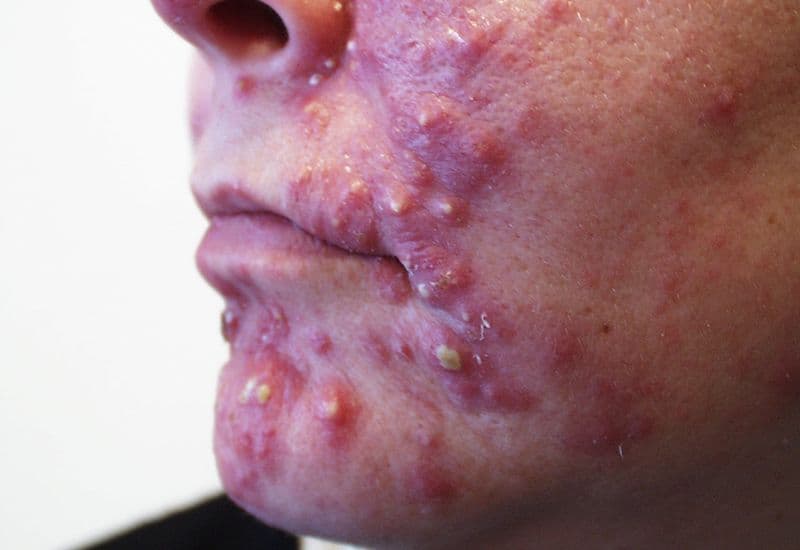 Mụn trứng cá nặng là gì?