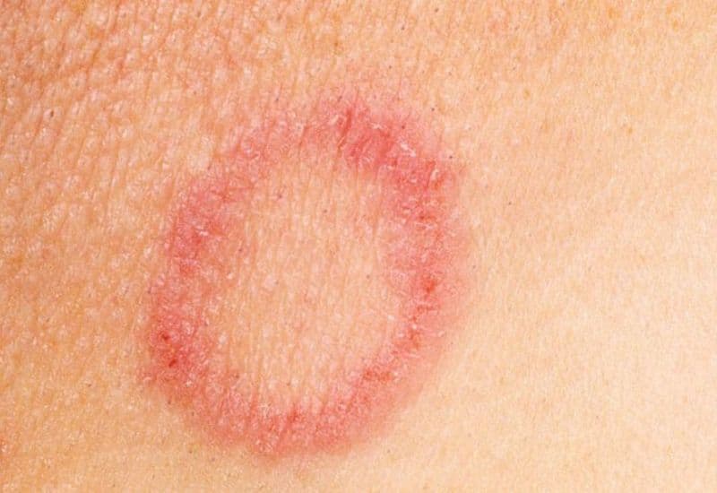 Các bệnh lý có thể sử dụng kem bôi da Soslac G3