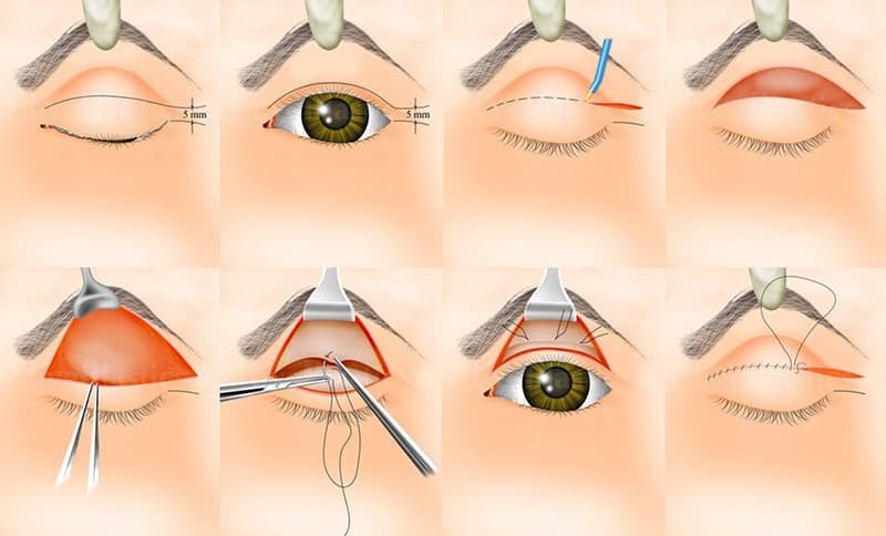 Một số hình ảnh về nâng cơ mi