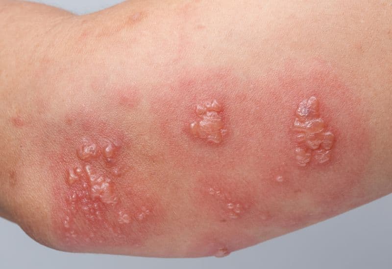 Nguyên nhân bị thủy đậu là gì?