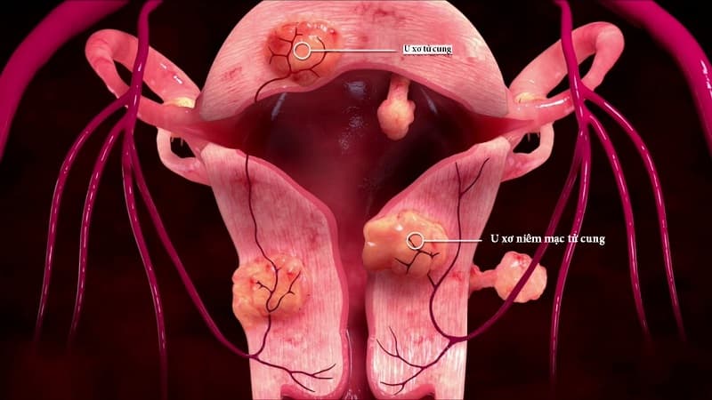 Một số vị trí khối u trong tử cung
