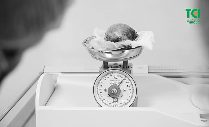 Một nhân xơ tử cung kích thước lớn