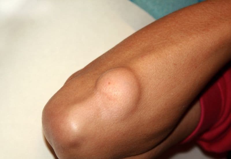 Biểu hiện u mỡ dưới da