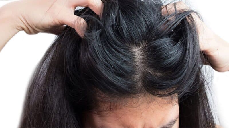 Nizoral là loại thuốc được cho là có thể điều trị bệnh lý nấm da đầu và một số bệnh lý nấm khác một cách hiệu quả.