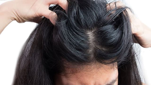 Dùng kem bôi Nizoral 10g trị nấm da đầu cần lưu ý gì?