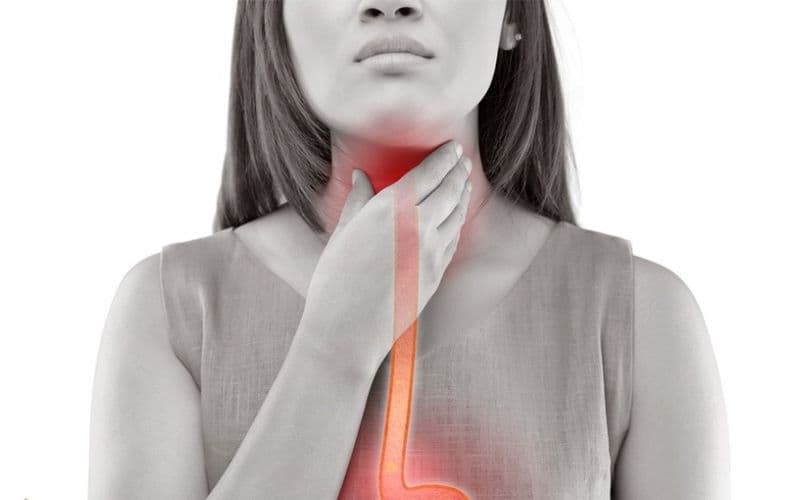 Trào ngược dạ dày thực quản (GERD) là một trong những nguyên nhân gây ra nuốt nghẹn ở cổ 