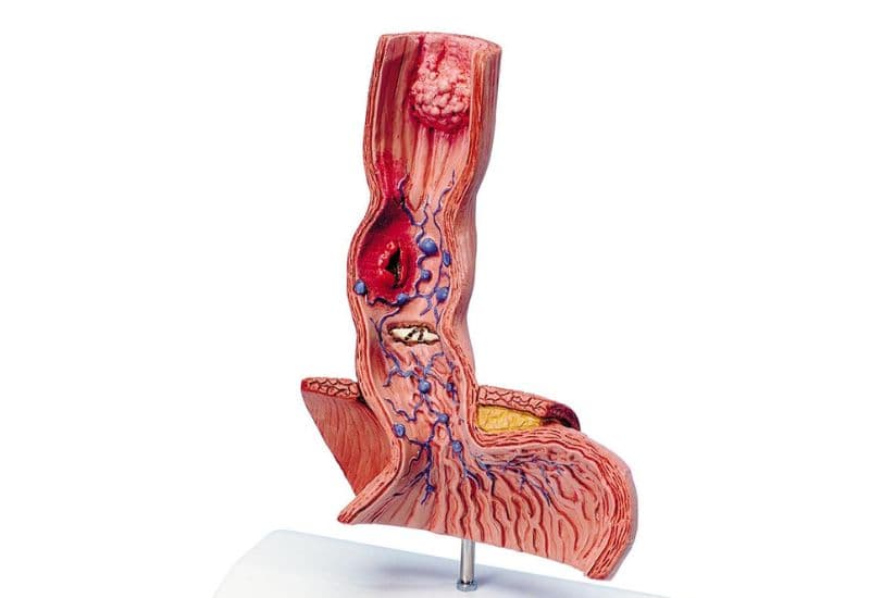 Ợ chua gây ra những bệnh lý gì?