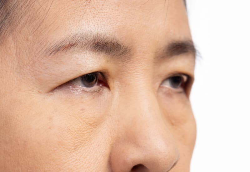 Sụp mí mắt có thể xuất hiện trên một hoặc cả hai mắt ở mọi đối tượng. 